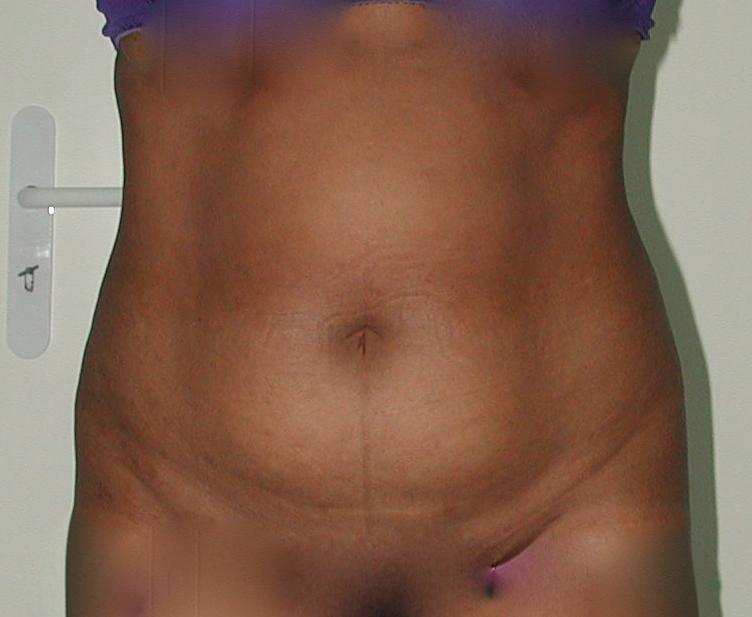 Lipoaspiration AVANT Ventre Face