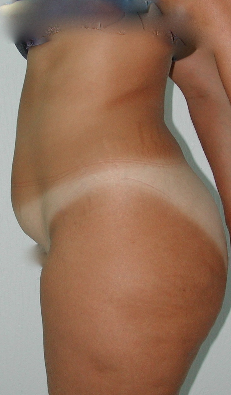 Lipoaspiration AVANT ventre profil