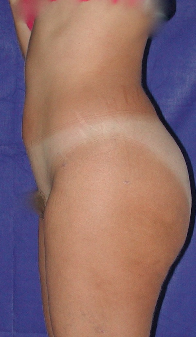 Lipoaspiration APRES Ventre Profil