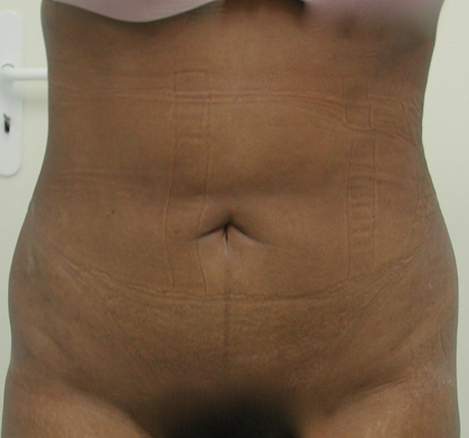 Lipoaspiration APRES Ventre Face