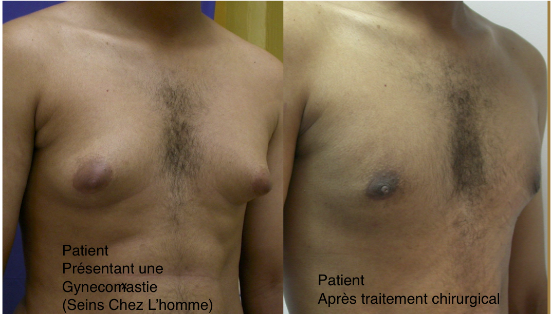 Gynecomastie