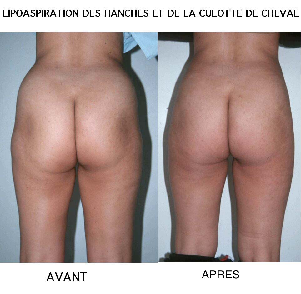 Lipoaspiration AVANT APRES