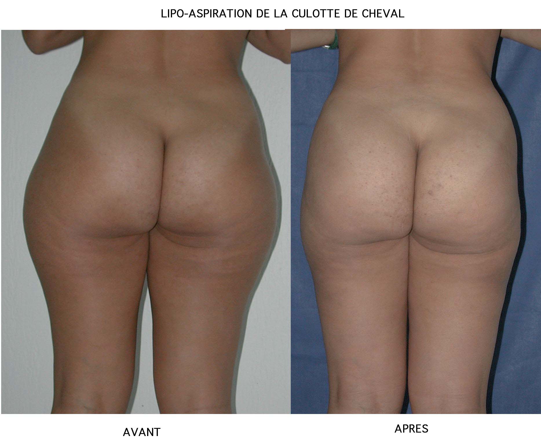 Lipoaspiration AVANT APRES